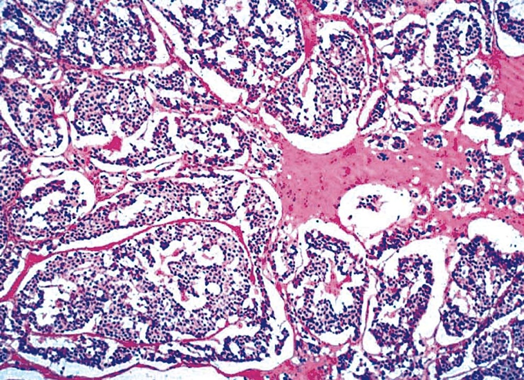 Pathology Outlines Medullary carcinoma